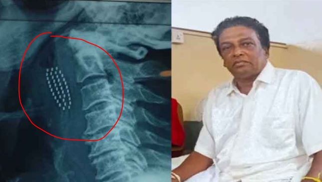 13 Brushing teeth turns life-threatening for Sri Lankan man