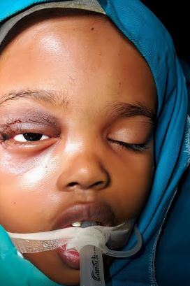 DNA 3-1 Pakistani hospital saves Somali girl from life-threatening eye tumor