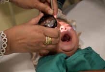 Al-Shifa Trust warns screening gaps raise blindness risk for premature babies Al-Shifa Trust warns screening gaps raise blindness risk for premature babies